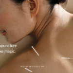 Best Acupuncture Bedford